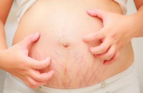 9 thay đổi về da ở phụ nữ mang thai có thể bạn chưa biết