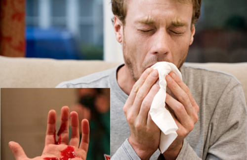 3 dấu hiệu cảnh báo nguy hiểm bạn đã mắc bệnh lao phổi
