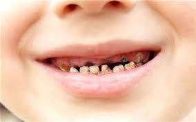 Cách nào phòng tránh sâu răng hiệu quả cho trẻ nhỏ hay ăn kẹo?
