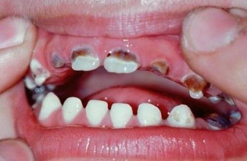Sâu răng - Nguyên nhân, cách phòng bệnh như thế nào?
