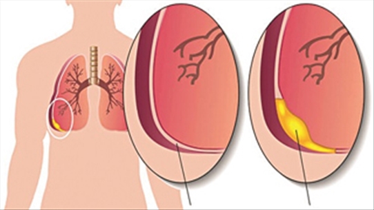 Dấu hiệu tràn dịch màng phổi không đơn thuần bệnh lao