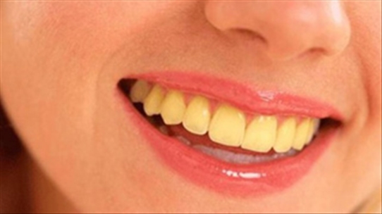 Răng đổi màu có phải là dấu hiệu đầu tiên của sâu răng không?