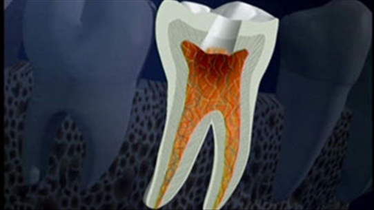 Viêm tủy xương hàm do sâu răng thì điều trị thế nào?