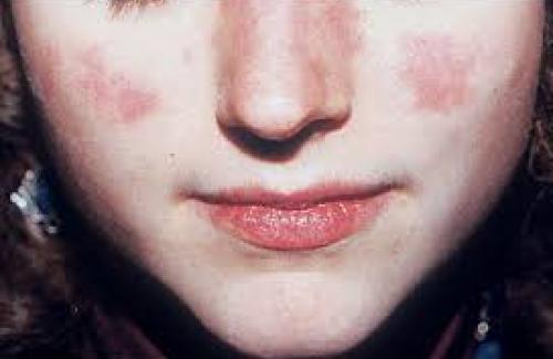 Nguyên nhân và triệu chứng của bệnh lupus ban đỏ hệ thống