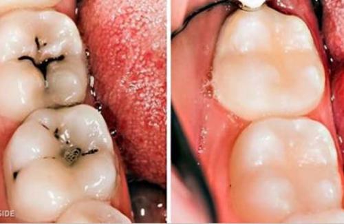 Bệnh sâu răng - nguyên nhân gây bệnh phổ biến nhất