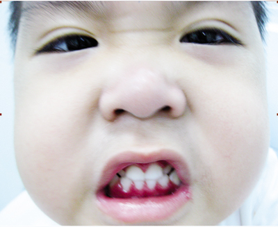 Bài thuốc chữa viêm lợi, miệng hôi ở trẻ răng sữa đơn giản hiệu quả
