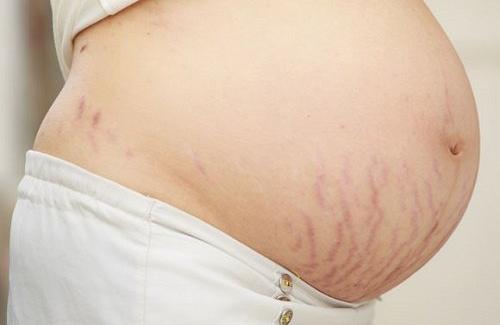 10 chiêu chống rạn da khi mang bầu mà các mẹ nên xem