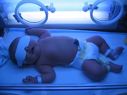 Vàng da ở trẻ sơ sinh - Khi nào cần điều trị là tốt nhất cho bé