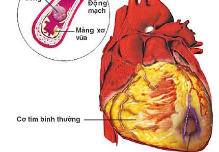 Xơ vữa động mạch - ngõ vào của nhiều bệnh, có thể bạn chưa biết