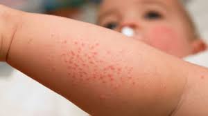 Trẻ bị mẩn ngứa, kiêng ăn gì để nhanh lành các vết trên da?