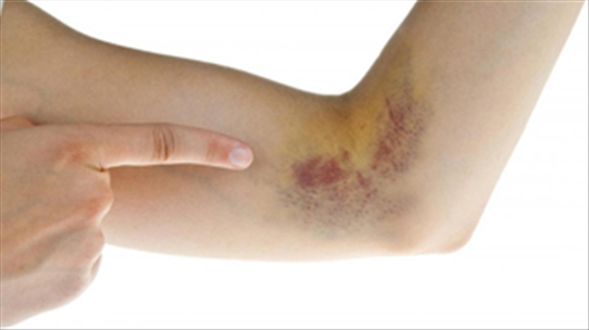 Vết bầm tím trên da có thể là dấu hiệu cảnh báo nhiều bệnh nguy hiểm