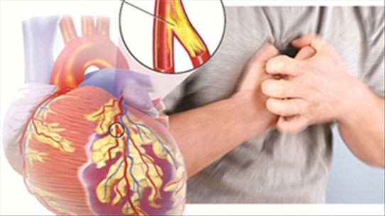 Biểu hiện những dấu hiệu sớm của bệnh động mạch vành mà bạn cần chú ý