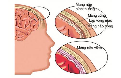 Phòng biến chứng nguy hiểm của viêm não, viêm màng não hiệu quả