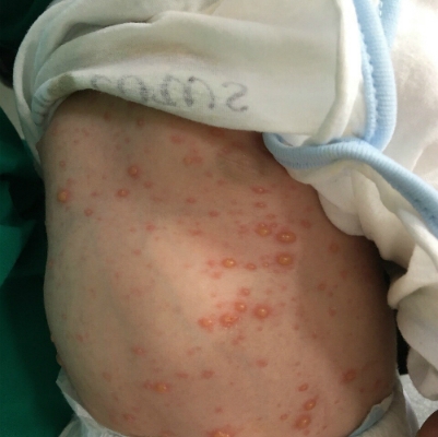 Mẹ mang thai không tiêm vắc xin phòng bệnh, bé trai mới 10 ngày tuổi đã “dính” thủy đậu