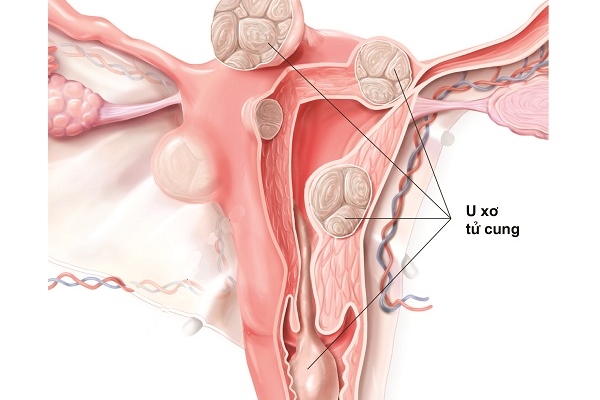 U xơ tử cung có thể chữa khỏi nhờ thần dược đến từ đậu nành