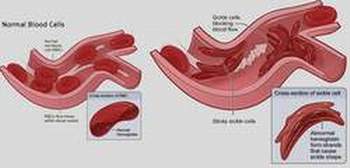 Tế bào gốc chữa khỏi bệnh thiếu máu hồng cầu hình liềm