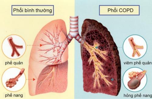 Bệnh phổi tắc nghẽn mạn tính ở người già và cách phòng tránh