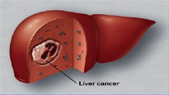 Ai dễ bị ung thư gan? Cùng tham khảo và tim cách phòng bệnh
