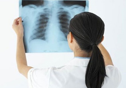 10 dấu hiệu cảnh báo sớm bệnh ung thư phổi mà bạn cần lưu ý
