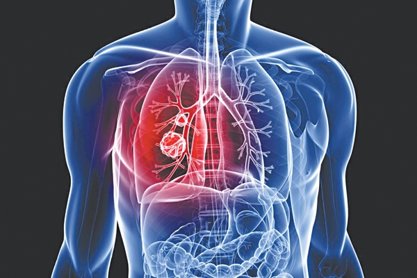 Để phát hiện ung thư phổi giai đoạn sớm không nên bỏ qua điều này