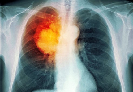 Làm sao để biết dấu hiệu của bệnh ung thư phổi, bạn đã biết chưa