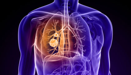 Bí quyết đơn giản phòng tránh ung thư phổi các bạn tham khảo nhé