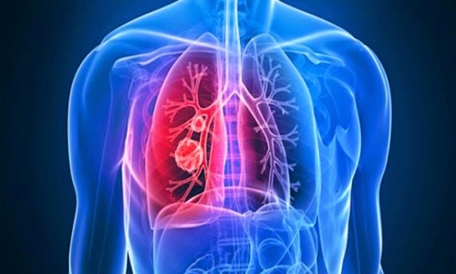 Những dấu hiệu cảnh báo ung thư phổi bạn chớ bỏ qua