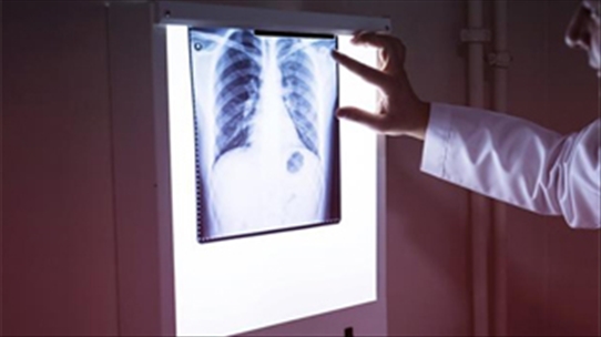 Ung thư phổi có thể đang tìm đến bạn nếu bạn thấy ra những dấu hiệu này