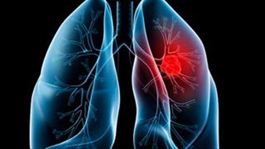 Điều trị ung thư phổi tế bào nhỏ tái phát như thế nào để đạt được hiệu quả