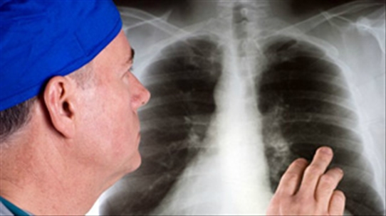 Ung thư phổi gây tử vong số 1 ở đàn ông, bạn biết tại sao không?