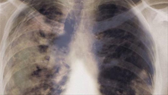 Ung thư phổi ở người trẻ đang tăng lên, nguyên nhân do đâu?