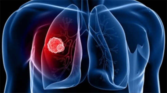 Ung thư phổi tăng gấp 4 lần, nguy cơ tử vong đứng hàng đầu