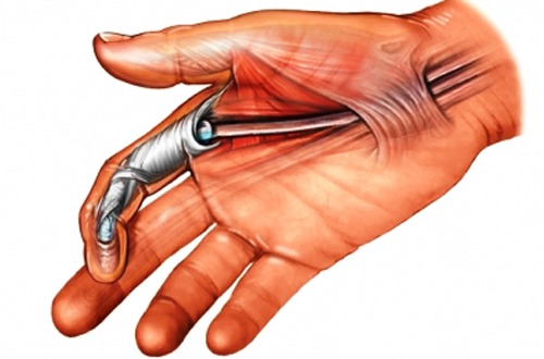 Nguyên nhân và mức độ nguy hiểm khi bị viêm bao gân ngón tay là gì?