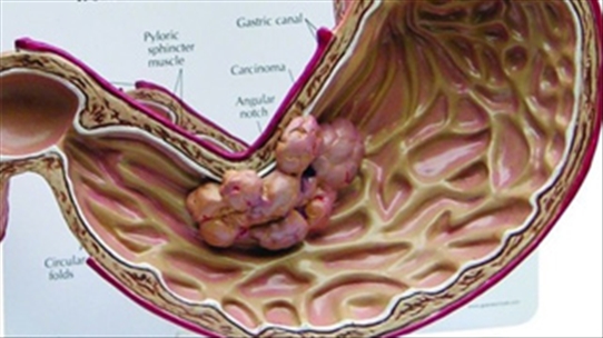 Nhiều người mắc ung thư dạ dày, sao biết mình bị bệnh hay không?