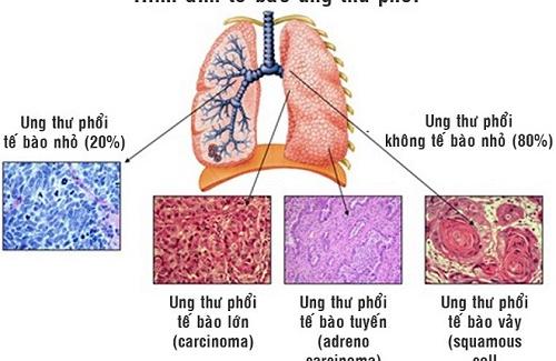 Ung thư phổi: Những quan niệm sai lầm về bệnh này mà ai cũng cho là đúng