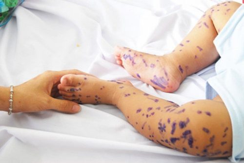 Nhiều trẻ mắc tay chân miệng, bác sĩ cảnh báo 3 dấu hiệu sớm chứng tỏ bệnh nặng