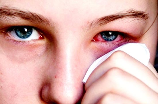 Cảnh báo khi tự điều trị đau mắt đỏ tại nhà, bạn nên lưu ý