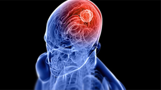 Ung thư phổi di căn: Xạ trị não là vô tác dụng - Vì sao lại vậy?