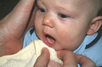 Các mẹ nên làm gì khi bé bị tưa lưỡi, cực phí nếu bạn bỏ qua