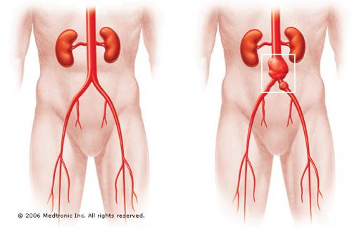 Phình động mạch chủ bụng - Nguyên nhân, dấu hiệu và cách điều trị