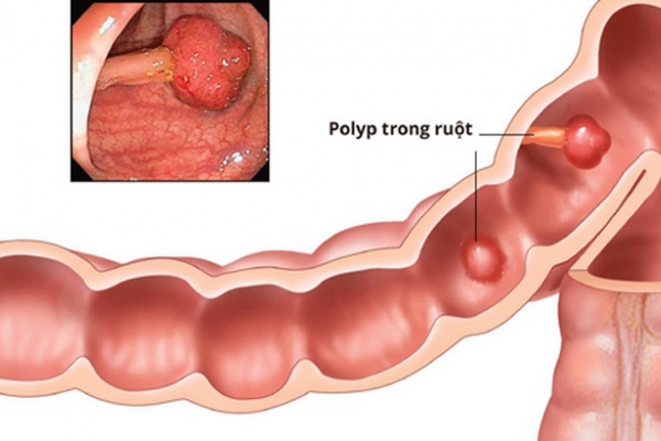 Cảnh báo: Phần lớn ung thư đường tiêu hóa phát triển từ polyp