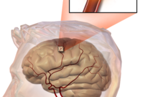 Nhận biết dấu hiệu khởi phát tai biến mạch máu não, có thể bạn chưa biết