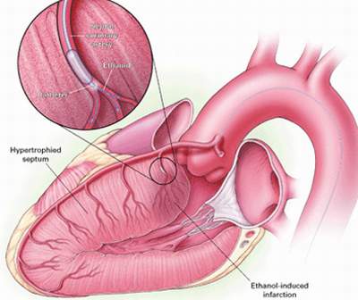 Phương pháp màu nhiệm xử trí bệnh cơ tim phì đại, bạn đã biết chưa?