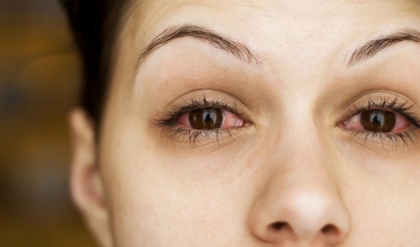 Mắt đỏ - dấu hiệu cảnh báo nhiều bệnh về mắt cần chú ý