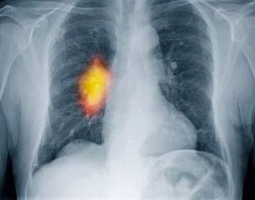 Hiểu biết về ung thư phổi - những thông tin quan trọng bạn cần biết