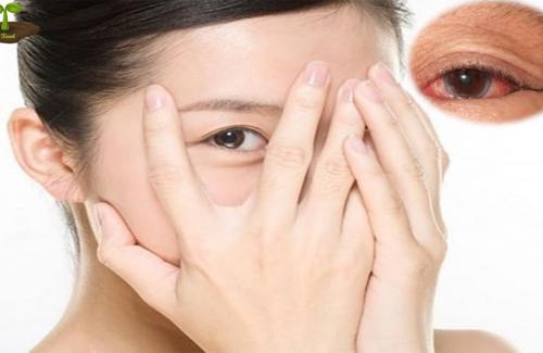 Các bệnh về mắt và cách điều trị để tránh những sai lầm đáng tiếc