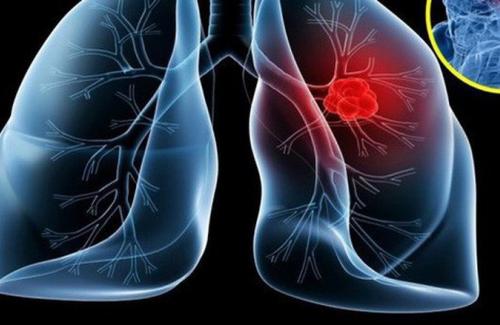 Những dấu hiệu không ngờ của bệnh ung thư phổi khiến bạn phải giật mình
