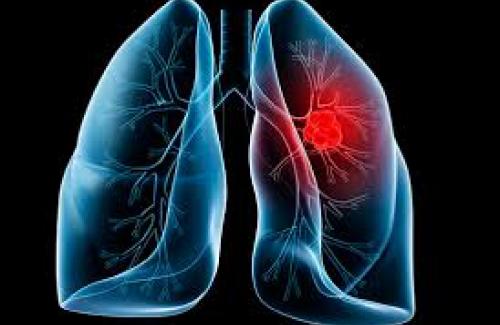 Bệnh ung thư phổi là nguyên nhân hàng đầu gây tử vong ở nam giới