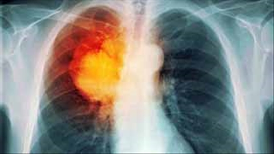 Phương pháp nhận biết những dấu hiệu cảnh báo sớm bệnh ung thư phổi