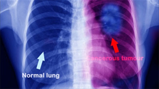 Điểm mặt những khó khăn trong điều trị ung thư phổi